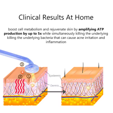 High Frequency Facial Machine Electrotherapy Wand FUSION Neon + Argon Wands Remove wrinkles Inflammation Acne Skin Care